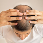 What is the most effective therapy for male loss of hair?