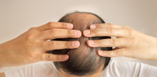 What is the most effective therapy for male loss of hair?