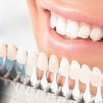 4 Factors You Ought To Consider Dental Veneers