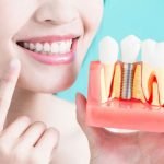Benefits of Oral Implants