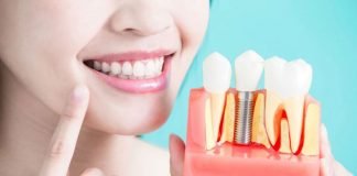 Benefits of Oral Implants