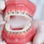 Why Adult Oral Patients Might Select Clear Aligners Over Steel Braces for Pearly Whites Straigtening