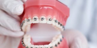 Why Adult Oral Patients Might Select Clear Aligners Over Steel Braces for Pearly Whites Straigtening
