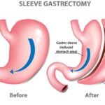 Gastric Sleeve – The Vertical Sleeve Gastrectomy is an Increasingly Popular Choice