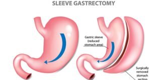 Gastric Sleeve – The Vertical Sleeve Gastrectomy is an Increasingly Popular Choice